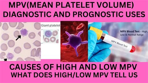 thrombocytopenia and mpv levels